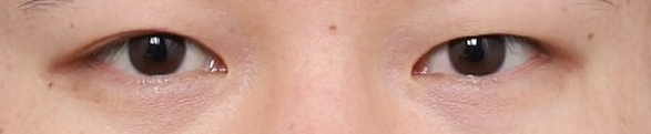 A Place Near Sinsa Station Known for Eye Surgery, Key Points for Improving the Eye Shape image 3