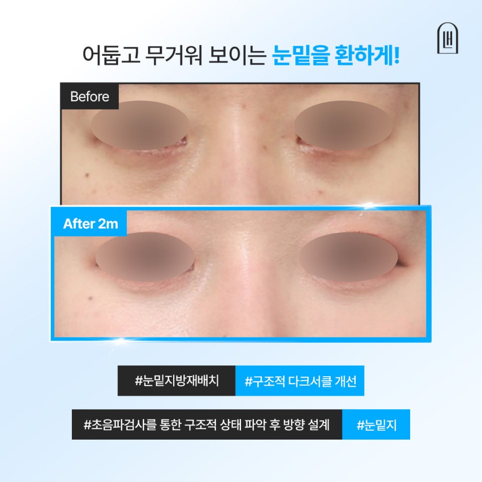 강남 눈밑지, 제대로 된 병원 선택하는 기준은 관련 이미지 1