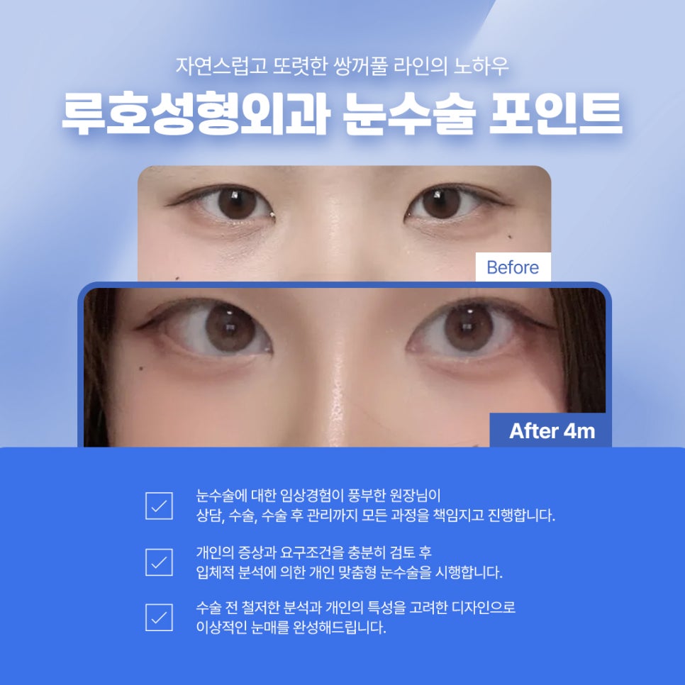 내 눈에 맞는 선명함을 찾은 인아웃라인 쌍꺼풀 후기 관련 이미지 4