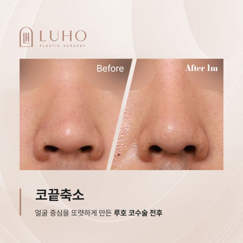 A Shinsegae Station Nose Surgery Review That Sharpened the Center of the Face with Tip Reduction image 1