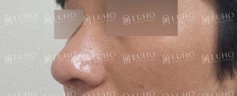 복코와 콧볼을 정리한 남자코수술, 어떤 부분이 바뀌었을까? 관련 이미지 9