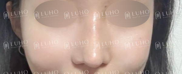 낮은 콧대와 둥근 코끝, 자연스럽게 정리한 코수술 전후 관련 이미지 8