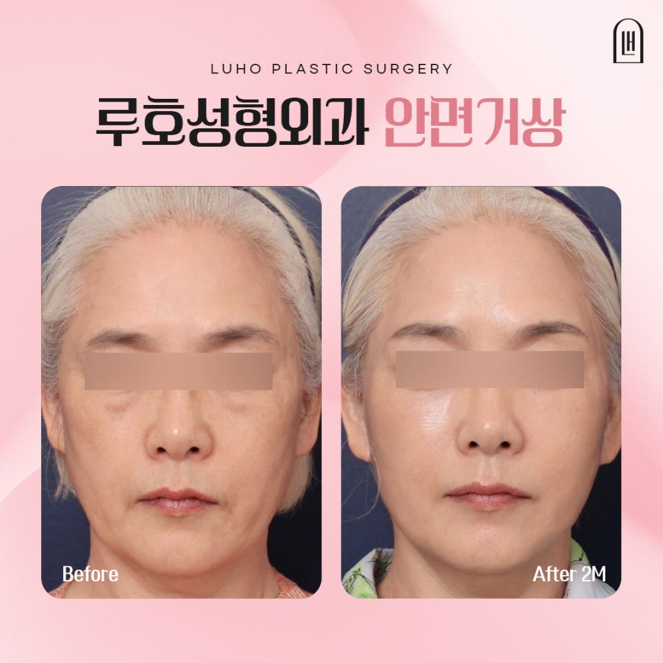 A Case of Facelift Surgery at Sinsa Station That Restored Weakened Midface Support image 1