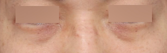 After Men’s Under-Eye Surgery at Sinsa Station That Reduced Dark Circles and Added Vitality image 3