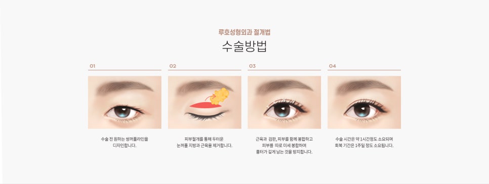 눈 수술법의 종류와 회복기간 #1 관련 이미지 1