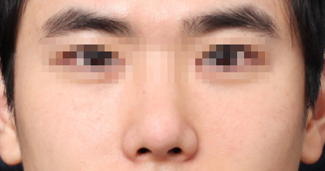 Shinsa Station Wide Nose Surgery, Center Line Neatened with Bridge Correction image 6