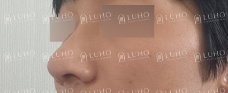 복코와 콧볼을 정리한 남자코수술, 어떤 부분이 바뀌었을까? 관련 이미지 7