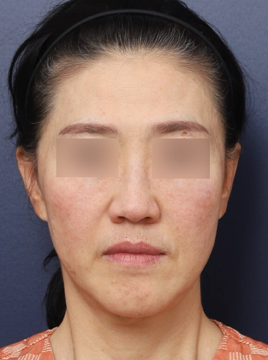 하안면 무게감을 줄인 신사역 중년 실리프팅 전후 관련 이미지 2