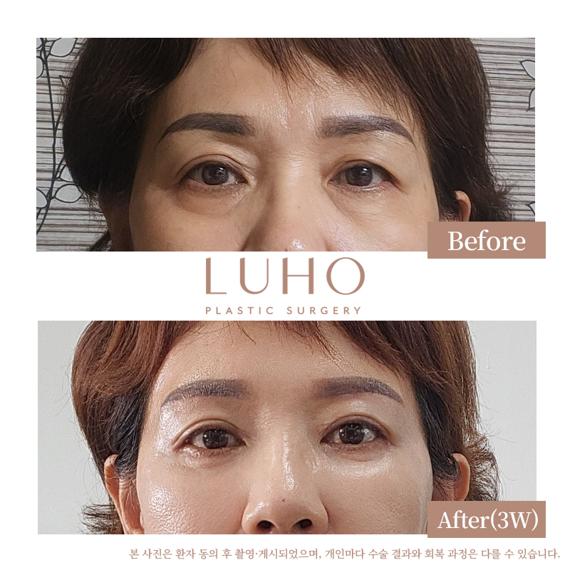 Sinsa Station Lower Eyelid Surgery Clinic: Real Before-and-After Comparison image 2