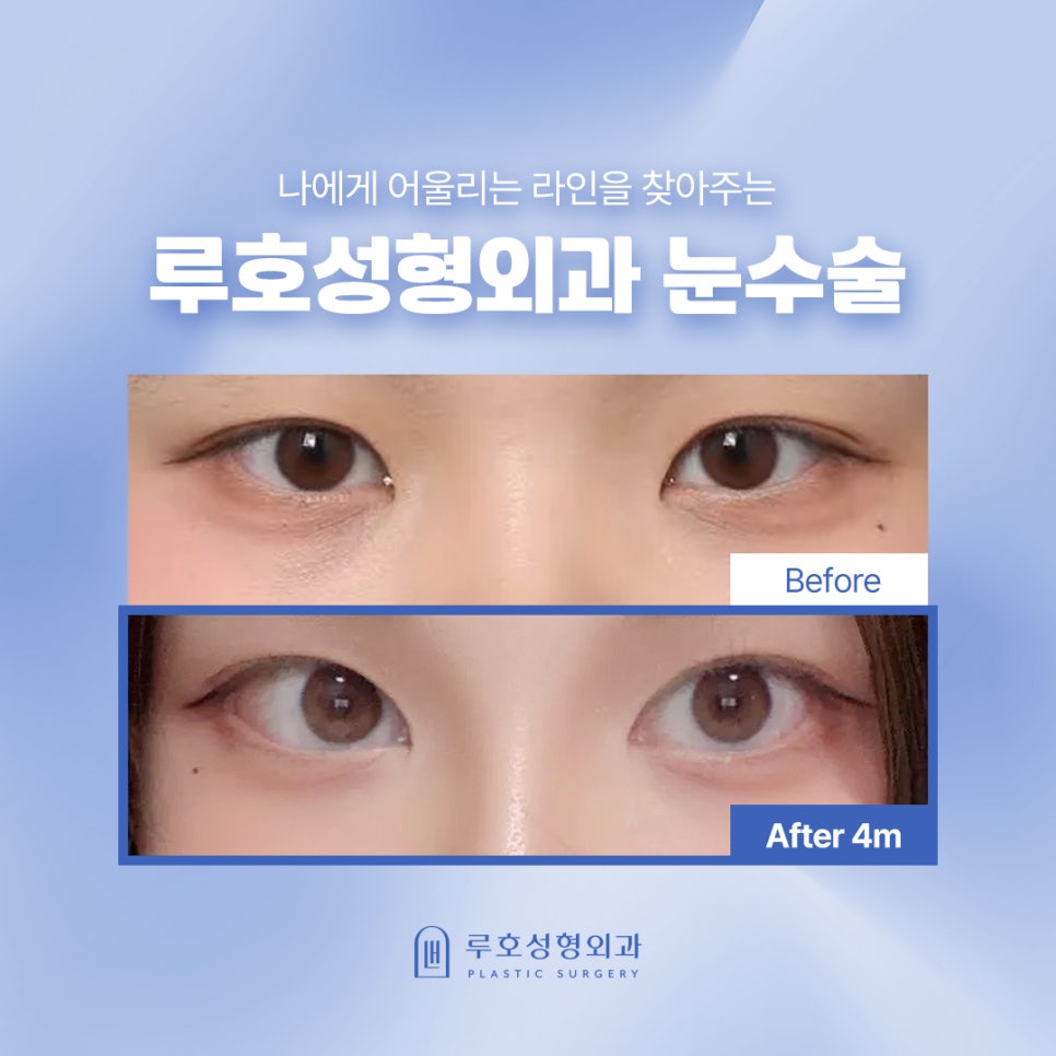 내 눈에 맞는 선명함을 찾은 인아웃라인 쌍꺼풀 후기 관련 이미지 1