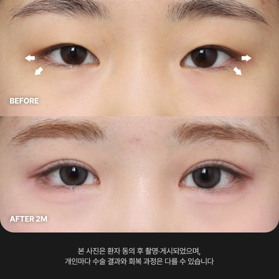 Ruhos Plastic Surgery — Real Review of Outer and Lower Eye Corner Surgery for Tired-Looking Eyes Before and After image 1
