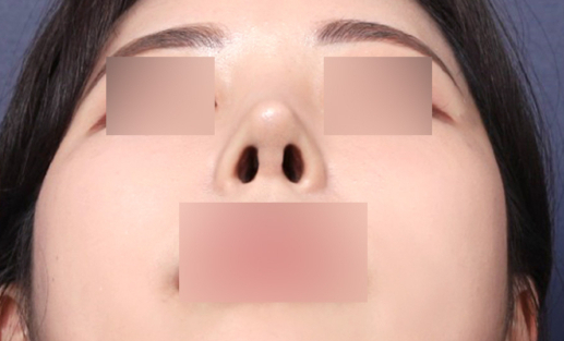 콧구멍 비대칭 교정, 신사역 성형외과 후기 살펴보기 관련 이미지 5