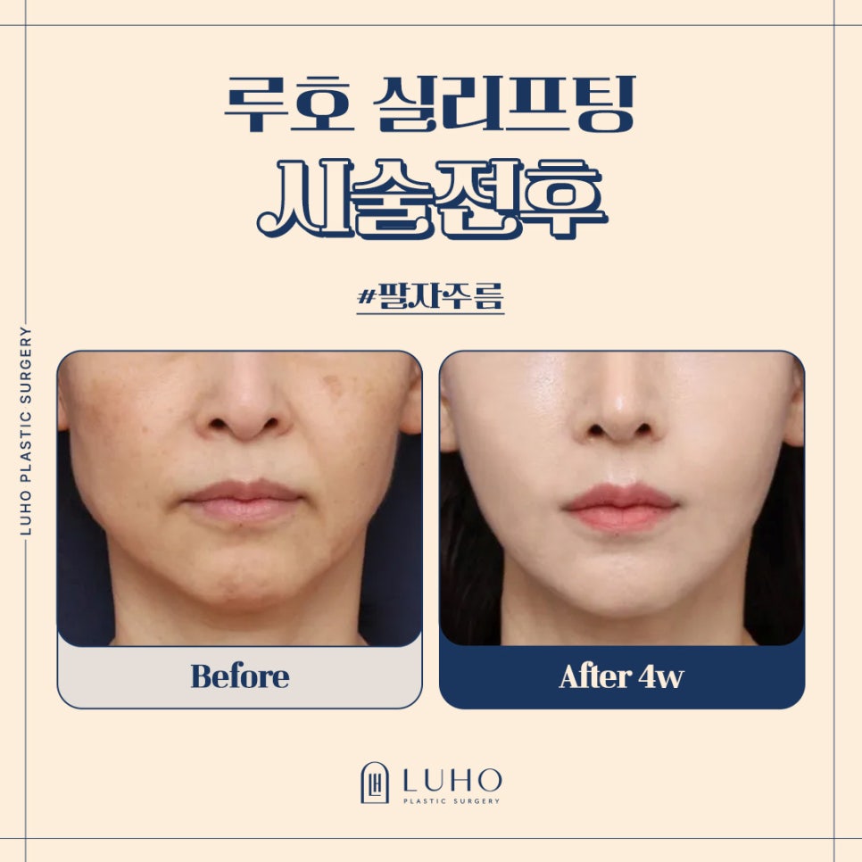 Reducing Nasolabial Folds, Before and After Thread Lifting at Sinsa Station image 1