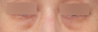 Sinsa Station Dark Circle Under-Eye Fat Repositioning Effect: A Review of Finding and Removing the Real Cause image 4