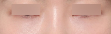 Reduce Deep Dark Circles and Brighten the Eye Area with Under-Eye Fat Repositioning at Sinsa Station image 5