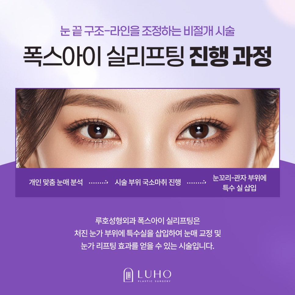 신사역 성형외과, 처진 눈꼬리를 개선한 실제 사례 관련 이미지 4