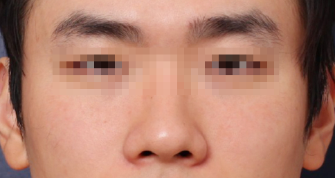 Shinsa Station Wide Nose Surgery, Center Line Neatened with Bridge Correction image 2