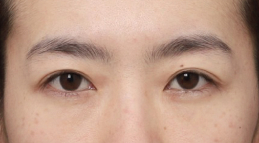 Could a Tired-Looking Appearance Change with a Forehead Lift in Gangnam at Sinsa Station? image 3