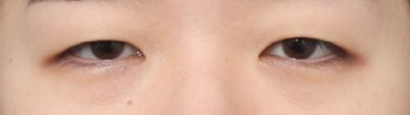 Before-and-After Review of Ptosis Correction with Double Eyelid Surgery Near Sinsa Station image 2