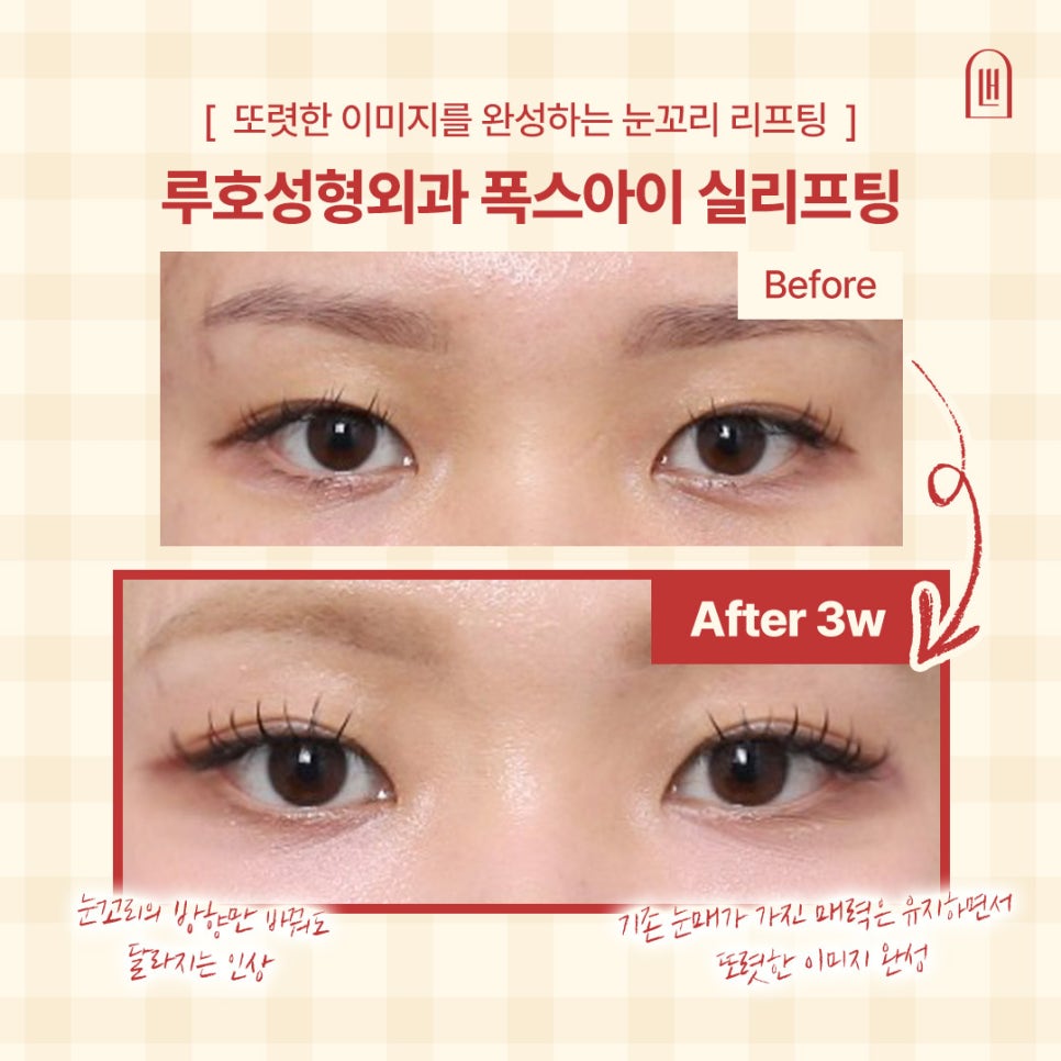 눈 크기는 그대로인데 인상이 달라졌다? 눈꼬리 리프팅 전후 관련 이미지 1