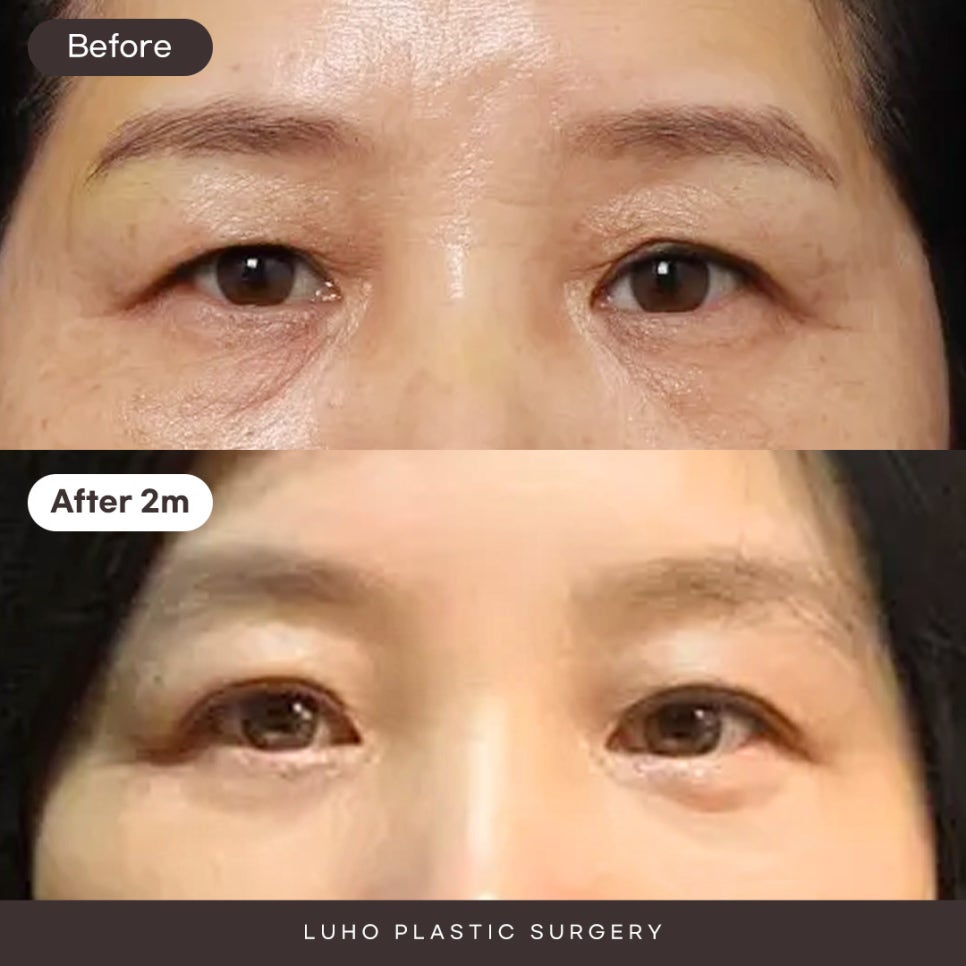 A Case of Correcting Midlife Eyelid Sagging with Upper Blepharoplasty at Sinsa Station image 1