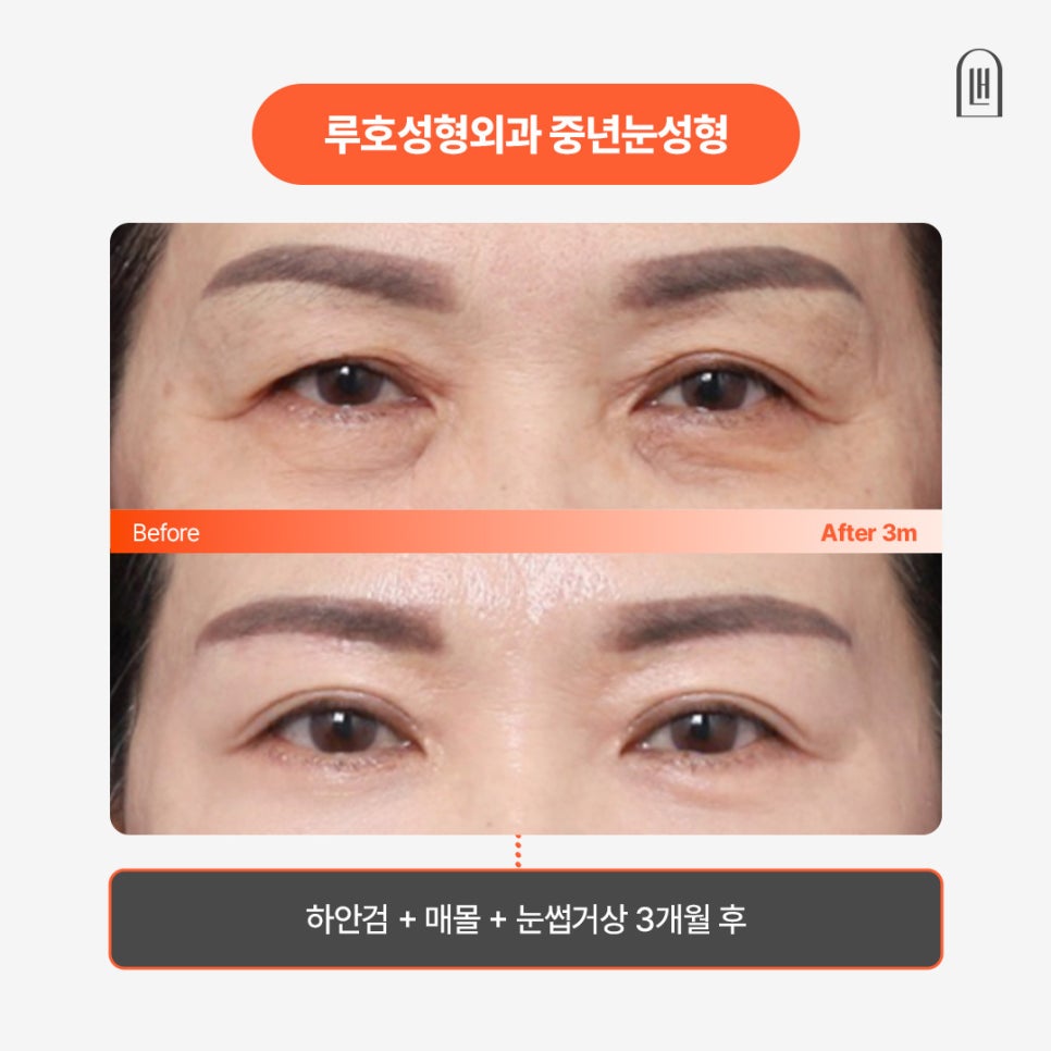 강남 신사역 중년눈성형, 수술 전 궁금한 Q&A 관련 이미지 1