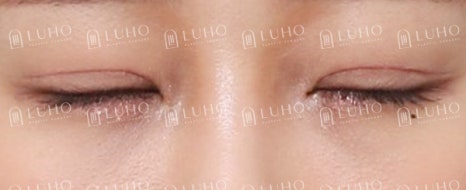 과거 수술 후 졸려 보이던 눈매를 교정한 눈재수술 관련 이미지 8