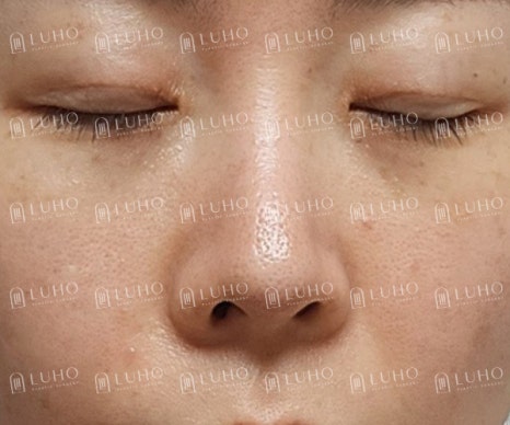 A Review of Eye & Nose Revision Surgery That Addressed the Shortcomings of Previous Surgery image 6