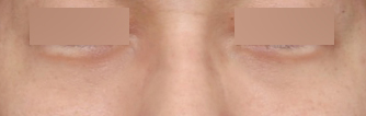 After Men’s Under-Eye Surgery at Sinsa Station That Reduced Dark Circles and Added Vitality image 5