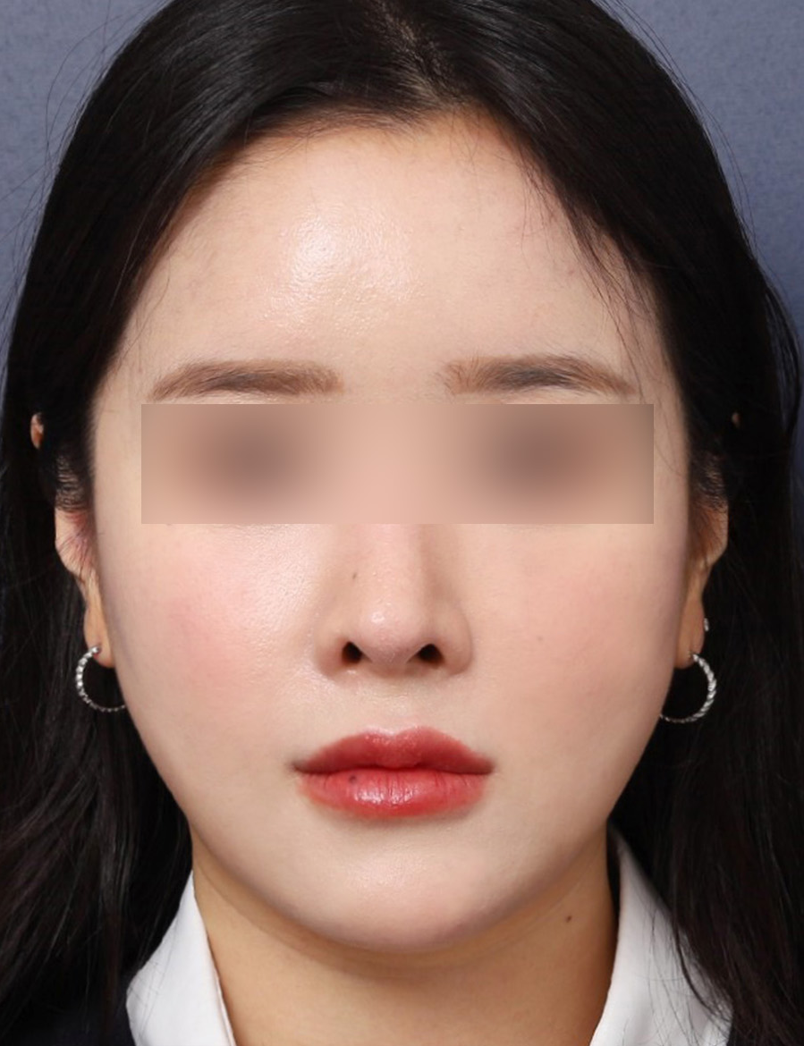 Before and After: Refining a Sagging Lower Face with Thread Lifting at Sinsa Station image 5