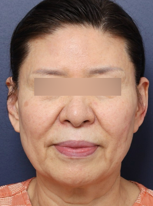Before and After Reveal of a Refined Jawline at a Place Known for Facelift Surgery Near Sinsa Station image 2