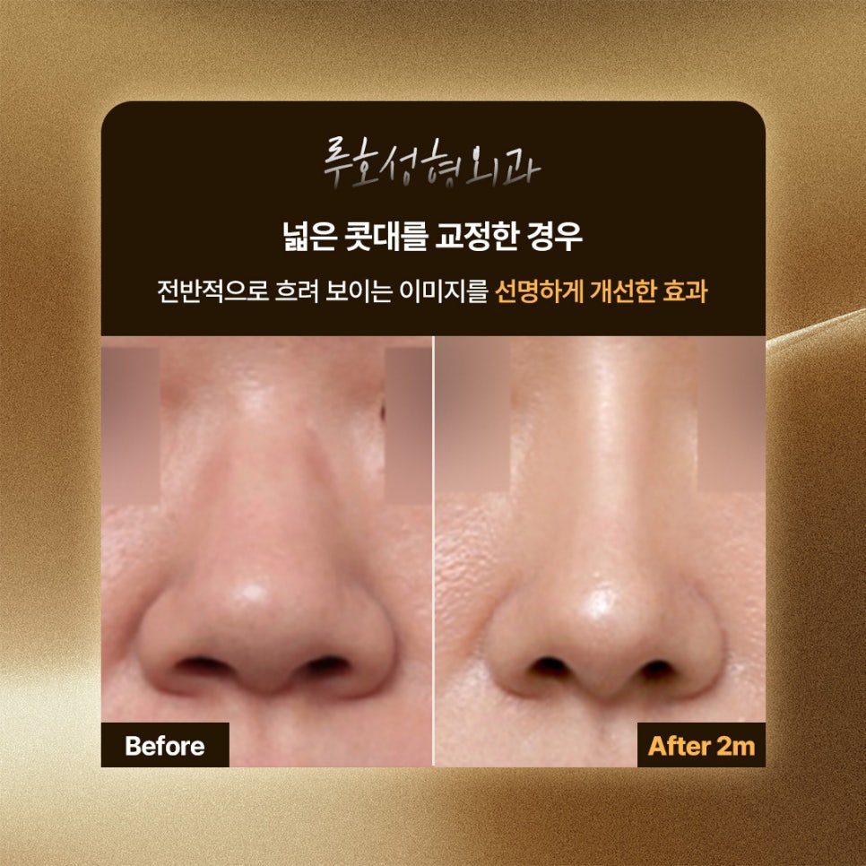 Before and After Nose Surgery Near Sinsa Station with a Refined Line Through Broad Nasal Bridge Correction image 1