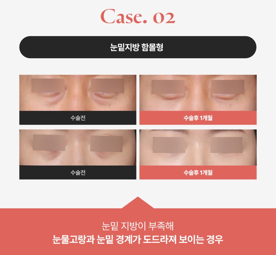 How to Get Rid of Dark Circles: A Look at Under-Eye Fat Repositioning Reviews Near Sinsa Station image 3