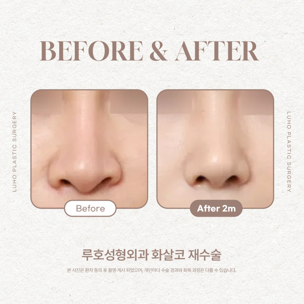 Changed Facial Appearance Through Arrow Nose Surgery at Sinsa Station image 1