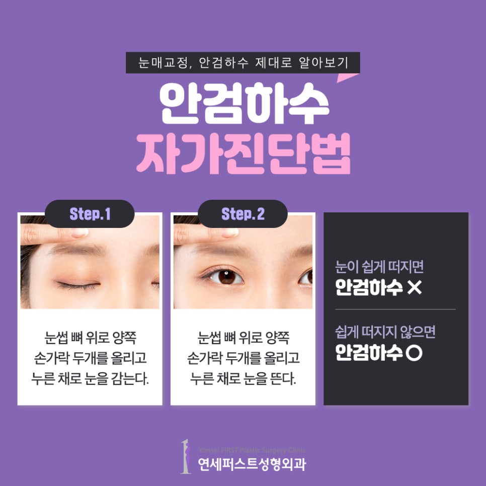 Is Eye Correction Surgery Really Necessary for Ptosis? image 6