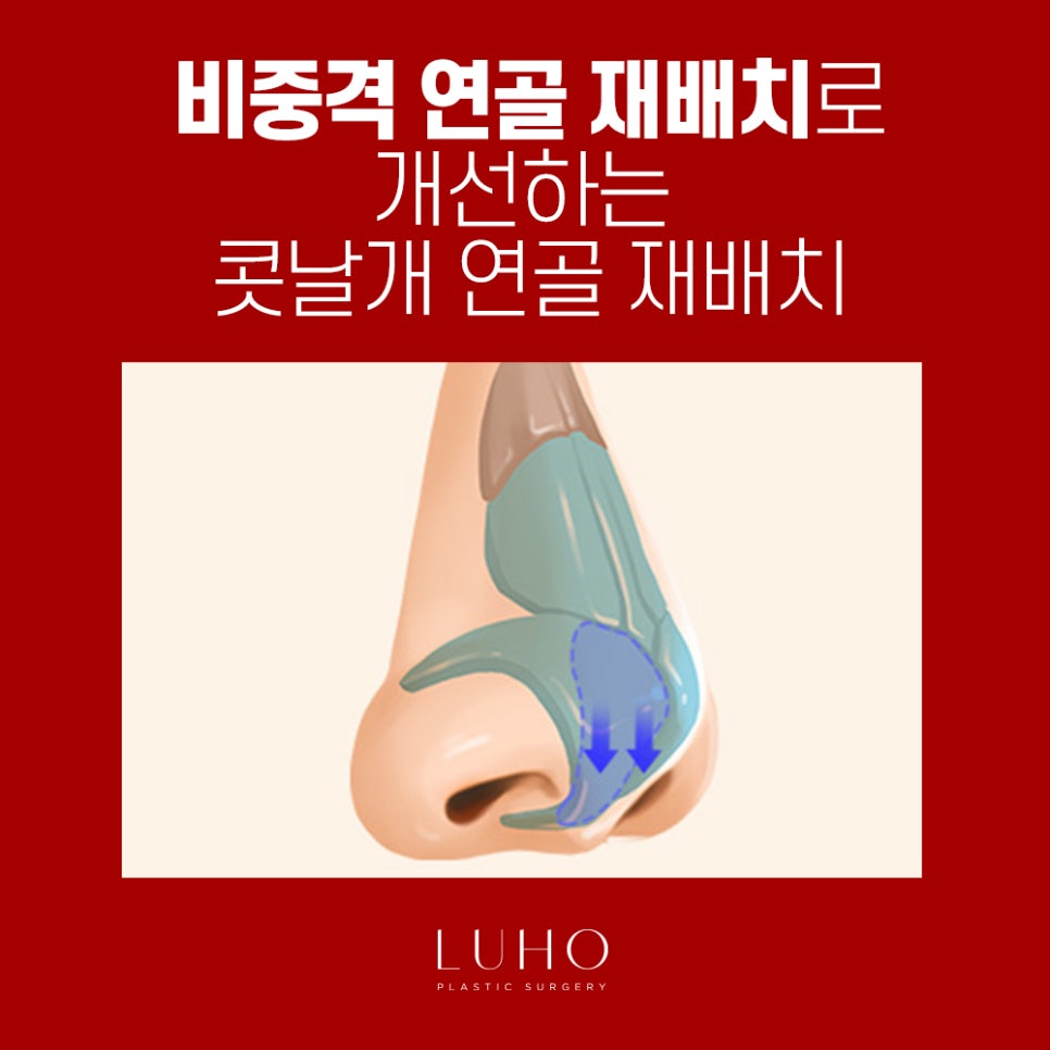 콧날개는 Down! 외모는 Up! 관련 이미지 5