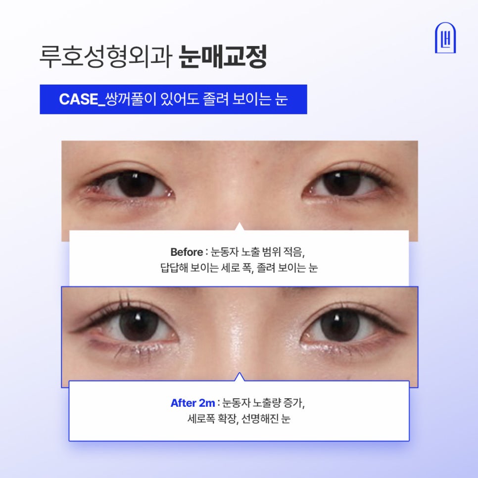 강남 신사역 안검하수 눈매교정 전후, 또렷함을 결정짓는 기준은? 관련 이미지 1