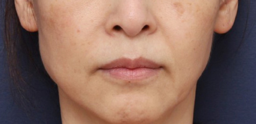Reducing Nasolabial Folds, Before and After Thread Lifting at Sinsa Station image 3