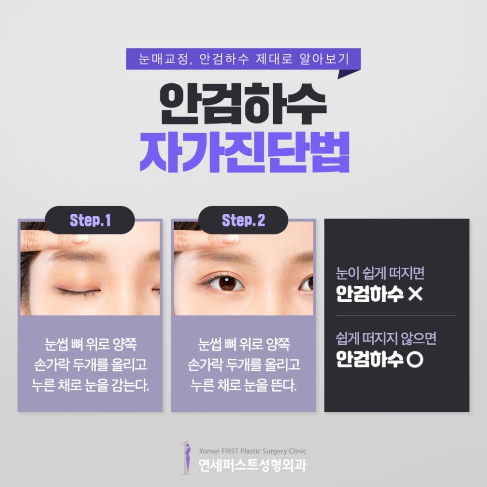 안검하수 제대로 알고 눈매교정 알아보자! 관련 이미지 4