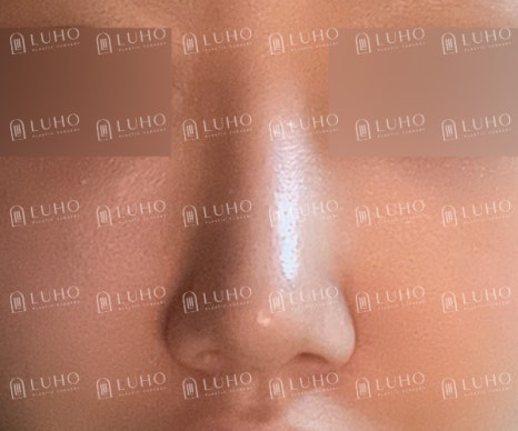 직반라인으로 디자인해 또렷한 존재감을 더한 코수술 효과 관련 이미지 6