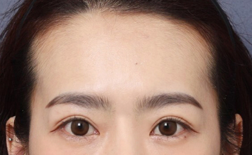 A Review of Forehead Lift Surgery at Sinsa Station That Completed a Natural Youthful Look image 5