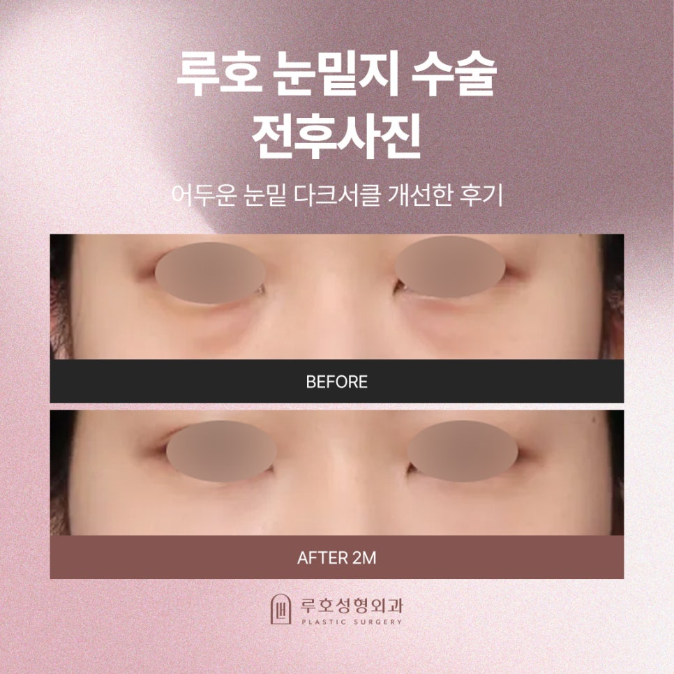 Dark Shadows Under the Eyes, a Different Look After Under-Eye Fat Repositioning Surgery at Sinsa Station image 1