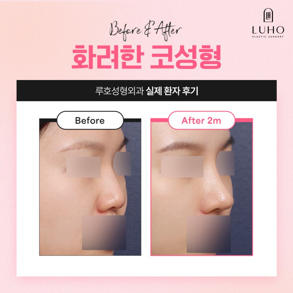 A Real Review of Nose Surgery at Luho Plastic Surgery, Customized to Fit My Face image 2