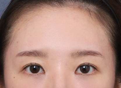 A Brighter Impression with an Endoscopic Forehead Lift to Correct Drooping Eyebrows image 5