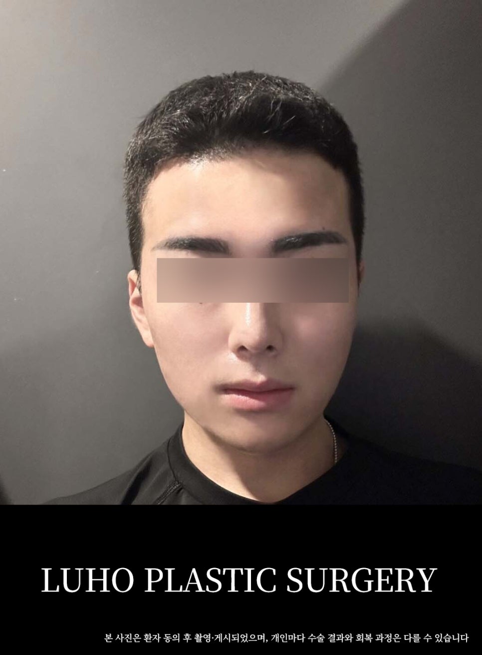 Real Before-and-After Review of Male Rhinoplasty at Luho Plastic Surgery Near Sinsa Station image 3