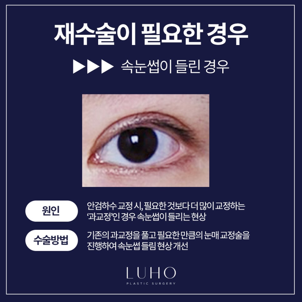 Double Eyelid Revision Surgery — Let’s Finish It at Luho! image 4