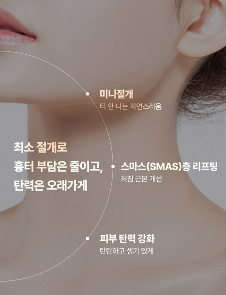 마리오네트 주름 해결한 신사역 안면거상술 효과 관련 이미지 3