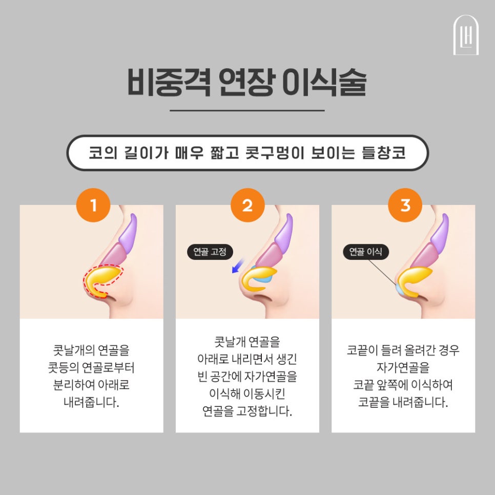 짧은코 들창코를 세련된 코로 관련 이미지 4