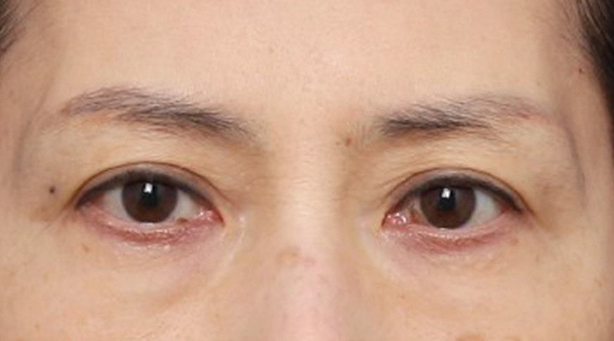 신사역 성형외과, 처진 눈꼬리를 개선한 실제 사례 관련 이미지 2