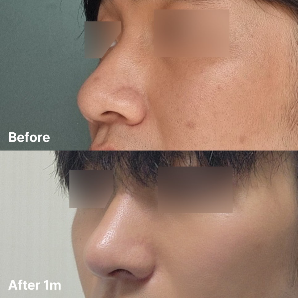 복코와 콧볼을 정리한 남자코수술, 어떤 부분이 바뀌었을까? 관련 이미지 1